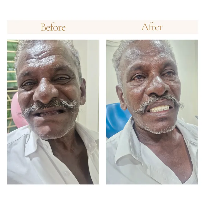 Before and after full mouth rehabilitation