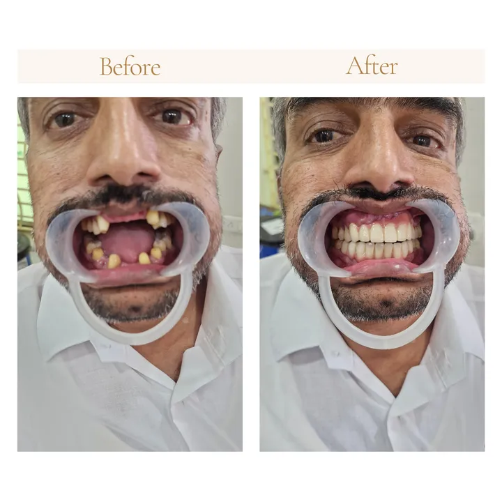 Before and after complete smile reconstruction